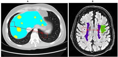 LLRHNet: Multiple Lesions Segmentation Using Local-Long Range Features